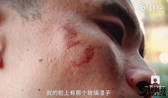 Poparzenia twarzy po wybuchu iPhone'a 7